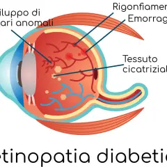 Illustrazione dell'occhio che mostra i danni della retinopatia diabetica: capillari anomali, emorragie e tessuto cicatriziale.