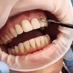 Zabieg lakierowania zębów w gabinecie stomatologicznym. Dentysta aplikuje preparat na zęby.