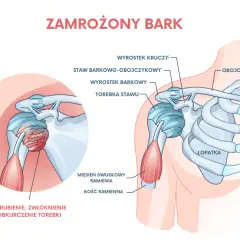 Ilustracja przedstawia zamrożony bark, z zaznaczonymi strukturami anatomicznymi, w tym torebką stawu, mięśniem dwugłowym ramienia i łopatką. Nerw przeponowy nie jest widoczny.
