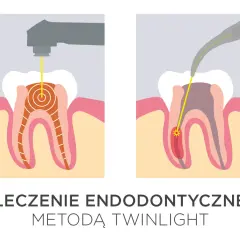 Ilustracja pokazuje laserowe leczenie zębów. Dwa etapy endodoncji z użyciem lasera, który precyzyjnie dociera do wnętrza zęba.