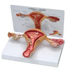 Model anatomiczny narządu rodnego kobiety z widocznymi jajnikami, macicą i jajowodami. Na tablicy informacyjnej zaznaczono patologie.