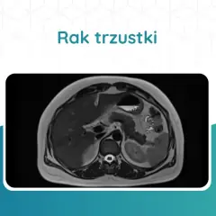 Tomografia rezonansu magnetycznego jamy brzusznej, ukazująca obraz raka trzustki. Jakie badania na trzustkę są kluczowe w diagnostyce.