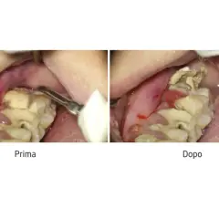 Prima e dopo la rimozione di un **tartaro grave**. La gengiva è infiammata e i denti sono coperti da depositi giallastri.