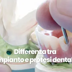 Modello dentale con impianti e una protesi dentale in fase di lavorazione.