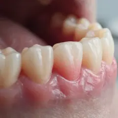 Opuchnięte dziąsła: Szybka ulga w domu i kiedy do dentysty?