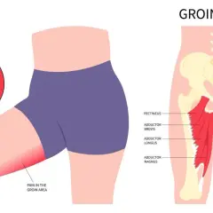 Illustration zeigt eine Zerrung der Adduktorenmuskeln im Leistenbereich. Wo ist die Leiste? Hier, rot markiert, mit Schmerz im Leistenbereich.