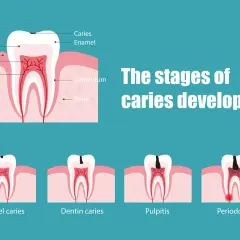 Ilustración muestra las etapas de desarrollo de una caries, desde el esmalte hasta la periodontitis, indicando cuándo empieza a doler una caries.