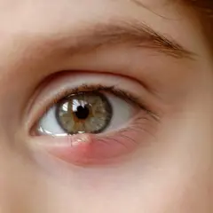 Un œil avec un bouton rouge et gonflé au coin de l'œil, près des cils.