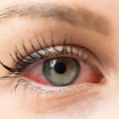 Rotes, gereiztes Auge mit sichtbaren Äderchen. Vielleicht ein Fall für Bindehautentzündung Hausmittel?