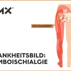 Darstellung des Ischiasnervs, der vom unteren Rücken bis zum Fuß verläuft. Das Krankheitsbild Lumboischialgie links zeigt eine Reizung dieses Nervs.