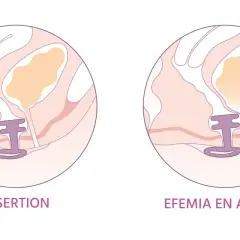 Illustration montrant l'insertion d'un dispositif pour le traitement naturel de la vessie irritée.