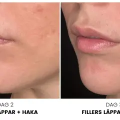 Före- och efterbilder av läppar och haka efter konsultation med fillers. Dag 2 och dag 3 visar en tydlig förbättring.
