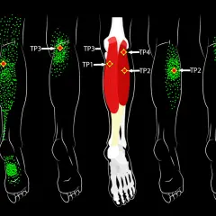 Schéma des jambes montrant des points verts indiquant des zones de douleur et des points rouges marquant la zone gâchette.