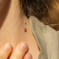 Gros plan sur le cou d'une personne montrant deux acrochordons, aussi appelés grains de beauté, près d'un col de vêtement.