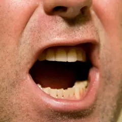 Primo piano di una bocca aperta, con denti visibili. La sensazione di bocca secca ansia è palpabile.