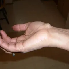 Polso con cisti tendinea visibile, una protuberanza sulla parte superiore.