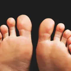 Piedi con alluce valgo, un problema comune per cui esistono diversi rimedi.