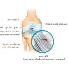 Ilustracja przedstawia kolano z zaznaczonymi więzadłami. Powiększony fragment ukazuje zerwane więzadło krzyżowe przednie (ACL), co jest przykładem nieleczonego zerwanego więzadła krzyżowego.