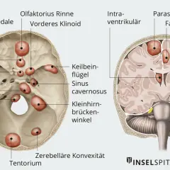 Anatomische Darstellung des Schädels mit roten Markierungen, die auf mögliche gutartige Tumoren im Kopf hindeuten. Symptome können je nach Lage variieren.
