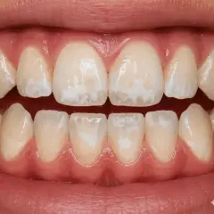Dientes con manchas blancas y opacas, indicando esmalte dental dañado.