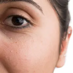 Nahaufnahme des Gesichts einer Frau mit kleinen, weißen Pickelchen, die als grain de milium bekannt sind, unter dem Auge.