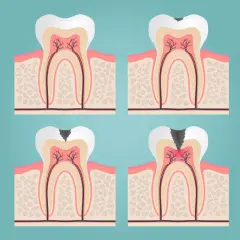 Ilustración de un diente con caries progresiva, mostrando la necesidad de un empaste o endodoncia para salvarlo.