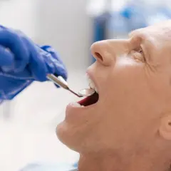 HPV w jamie ustnej: Do jakiego lekarza? Objawy i leczenie
