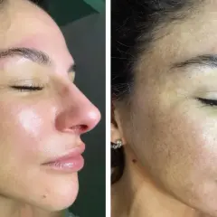 Viso prima e dopo acido mandelico: pelle più luminosa e uniforme, macchie attenuate.