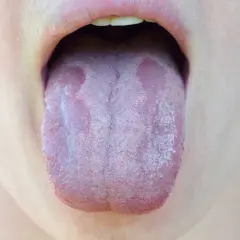 Lingua con placche biancastre, suggestive di candida lingua.