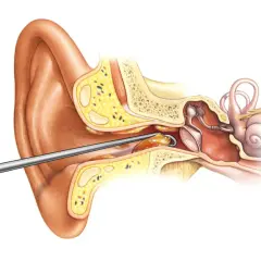 Instrumento extrae un tapón de cera del oído. El cerumen obstruye el canal auditivo, afectando la audición.