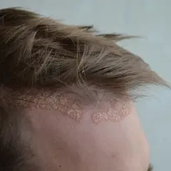 Dermatite seborroica e psoriasi sul cuoio capelluto: chiazze squamose e arrossate lungo l'attaccatura dei capelli.