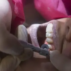 Dentysta wygładza ostry brzeg kości po usunięciu zęba, używając małego wiertła.