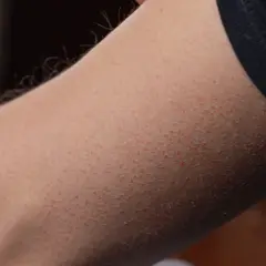 Widoczny trądzik na ramionach, drobne czerwone krostki pokrywające skórę.