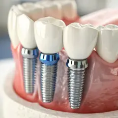 Tres implantes dentarios de titanio con coronas blancas, anclados en encías rosadas, listos para devolver una sonrisa.