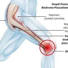 Anatomia bólu kolana przy zespole pasma biodrowo piszczelowego. Czerwony obszar bólu ITBS zaznaczony na kolanie.