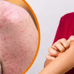 Rote, entzündete Haut mit vielen kleinen Pickelchen am Arm, die jucken. Hitzepickel am Arm sind unangenehm.