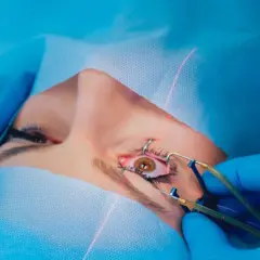 Zbliżenie na oko pacjenta podczas laserowej korekcji wzroku, z widocznym laserem i narzędziami chirurgicznymi.