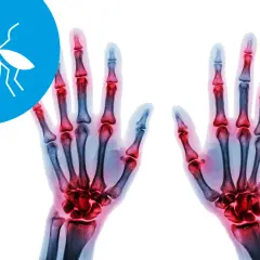 Rentgen dłoni z zapaleniem stawów, objawem choroby chikungunya. Komar symbolizuje przenoszenie wirusa.