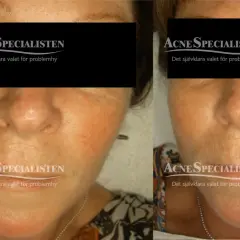 Före- och efterbilder visar resultat av ipl-behandling ansikte. Huden ser jämnare och klarare ut.