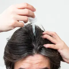 Persona aplica un gotero en su cuero cabelludo, buscando alternativas al minoxidil para el crecimiento capilar.