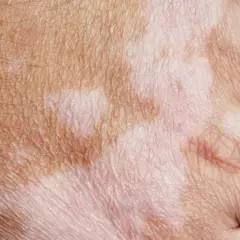 Haut mit helleren und dunkleren Flecken, die auf die **Pigmentflecken Ursache** hinweisen könnten.