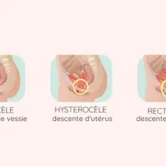 Illustration médicale montrant un prolapsus de la vessie stade 2 (cystocèle), une descente de l'utérus (hystérocèle) et une descente du rectum (rectocèle).