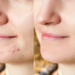 Avant/après : une peau avec des boutons et des pores dilatés devient lisse et nette. Découvrez comment faire disparaitre un bouton pour un teint parfait.