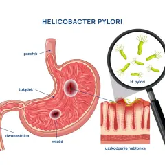 Schemat żołądka z wrzodami i bakteriami Helicobacter pylori. Uszkodzenie nabłonka żołądka przez H. pylori. Objawy skórne nie są widoczne.