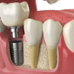 Impianto dentale che sostituisce un dente mancante, soluzione per l'edentulia.