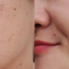 Comparación de piel: antes con manchas y poros visibles, después con piel lisa y uniforme.