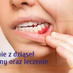Krwotok z dziąsła? Zatamuj go natychmiast! Przyczyny i porady