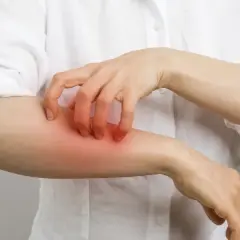 Une personne se gratte le bras, la peau rougie et irritée, possiblement à cause d'une allergie au calcaire.
