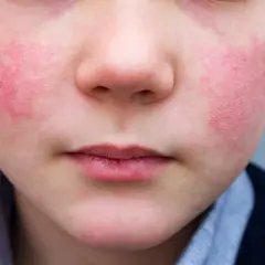 Primo piano del viso di un bambino con guance rosse e calde, forse per il freddo o un'allergia. La pelle appare leggermente screpolata.