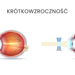 Jak wyleczyć krótkowzroczność i poprawić jakość widzenia?